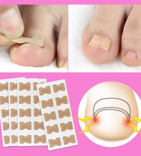 Ingrown Toenail Corrector Stickers