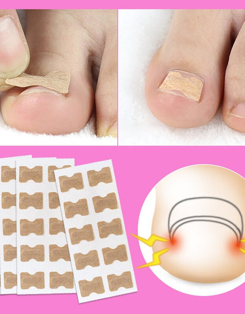 Load image into Gallery viewer, Ingrown Toenail Corrector Stickers
