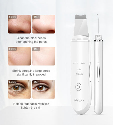 Ultrasonic Skin Lift Machine