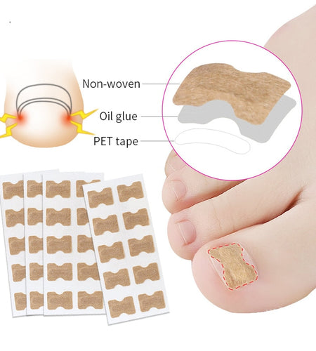 Ingrown Toenail Corrector Stickers